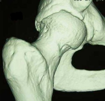 3d reconstruction of pincer lesion in FAI